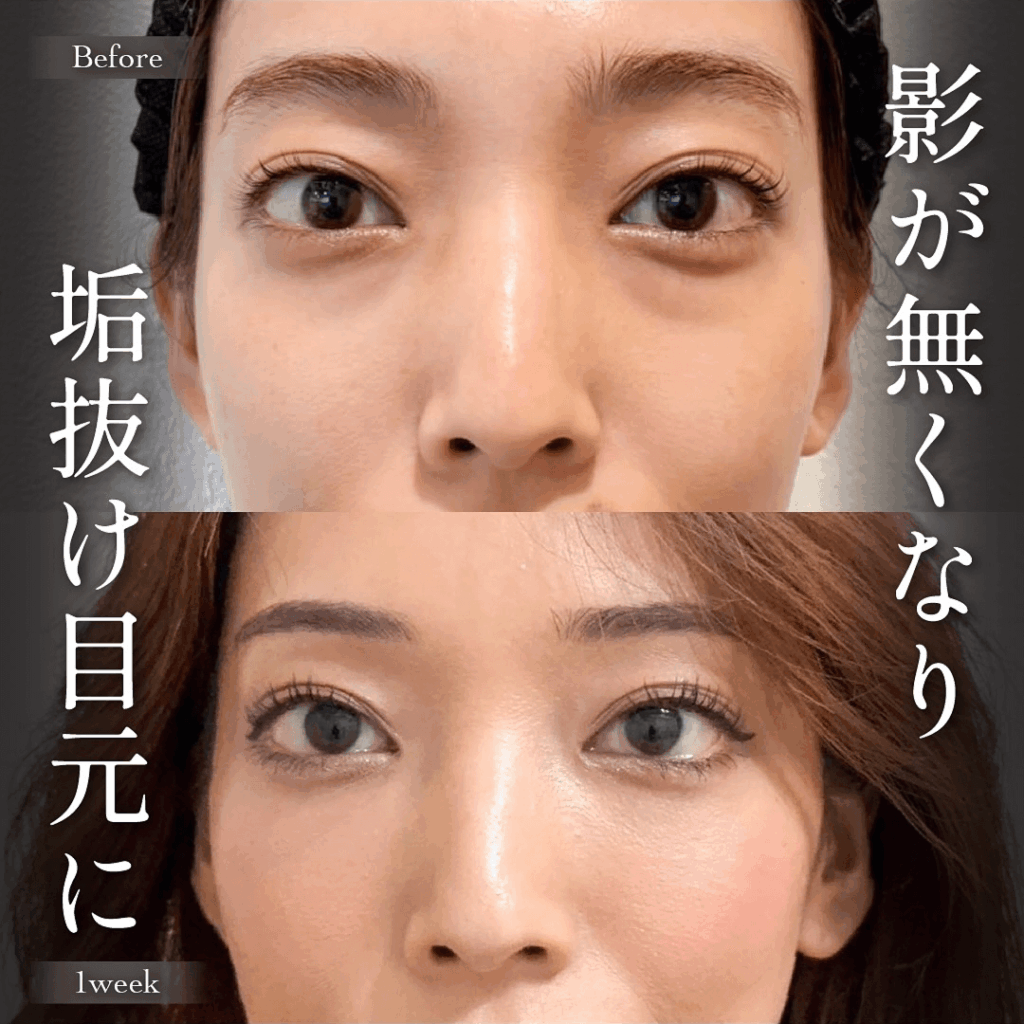 目の下のクマ取り 裏ハムラ