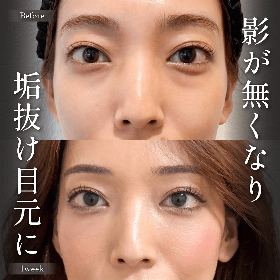 目の下のクマ取り 裏ハムラ