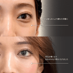 目の下のクマ取り 裏ハムラ