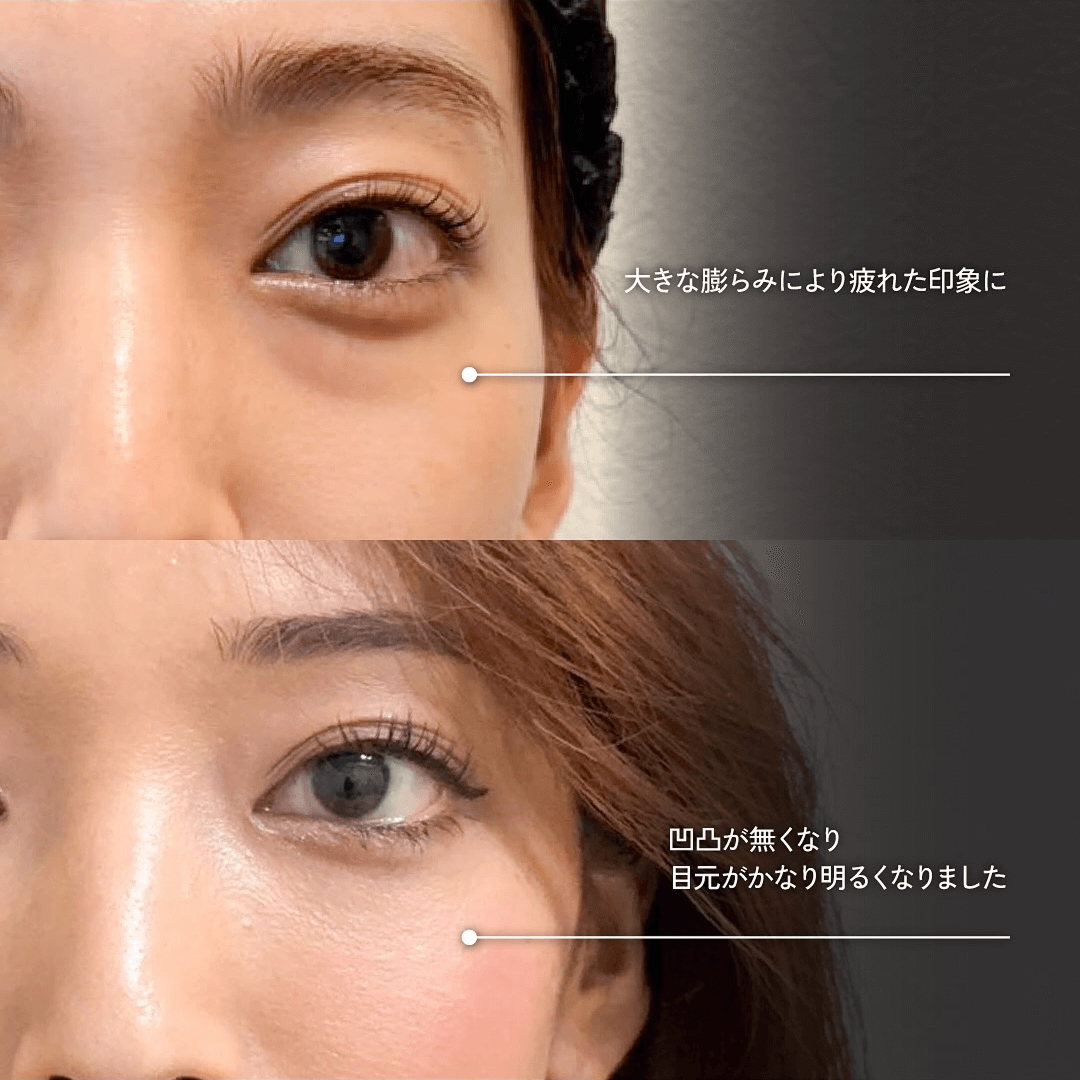 目の下のクマ取り 裏ハムラ