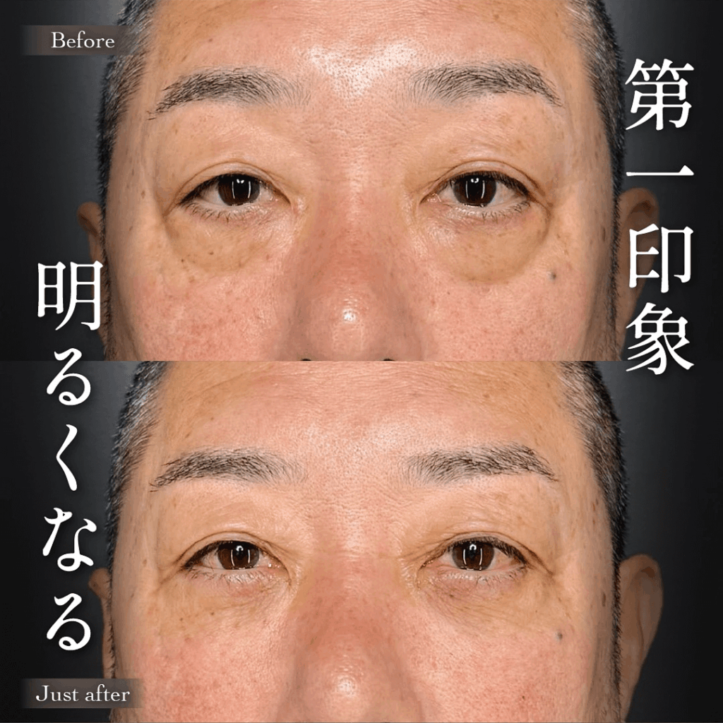 目の下のクマ取り ヒアルロン酸