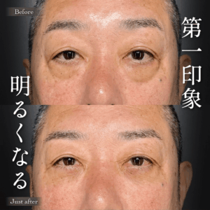 目の下のクマ取り ヒアルロン酸