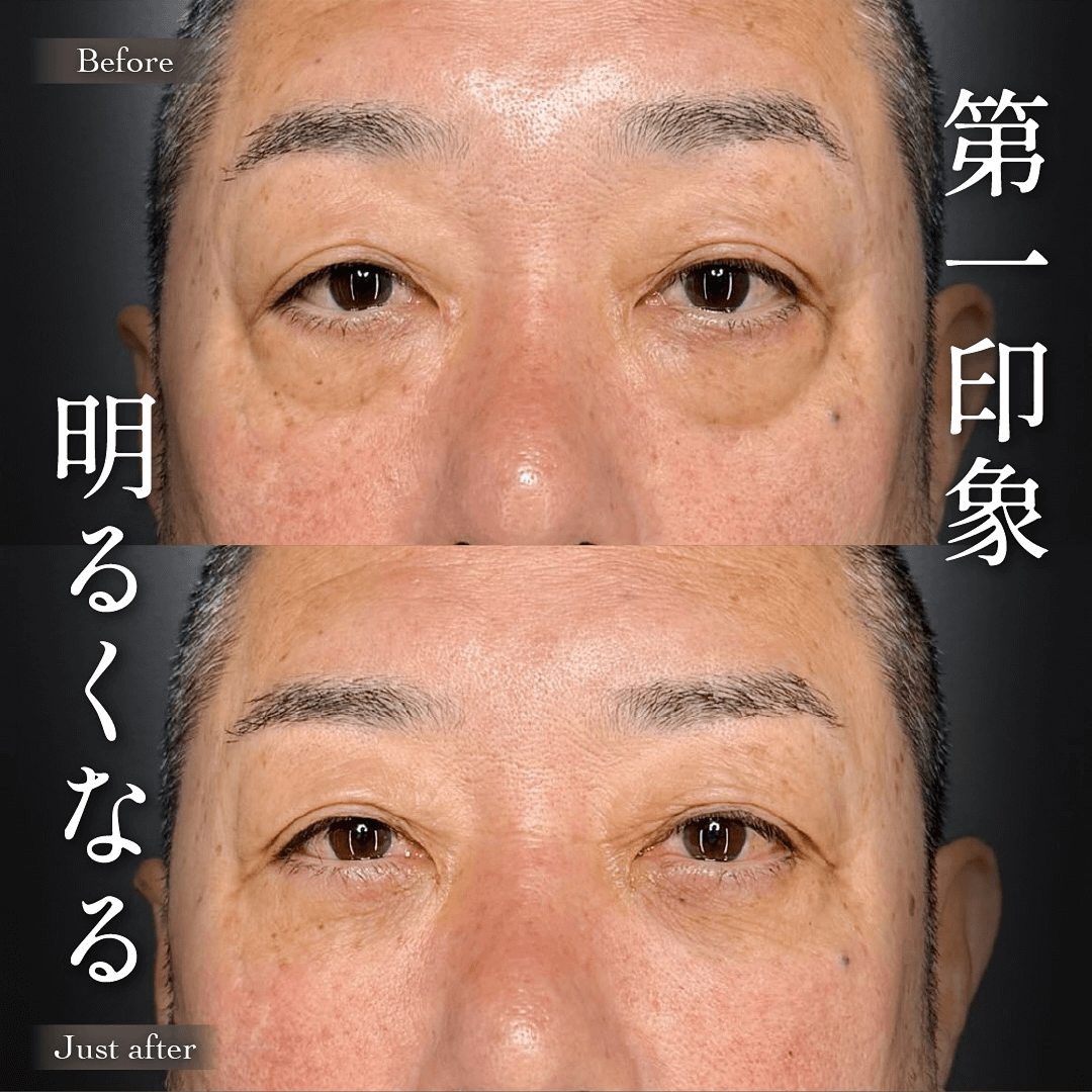 目の下のクマ取り ヒアルロン酸