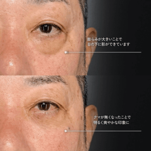 目の下のクマ取り ヒアルロン酸