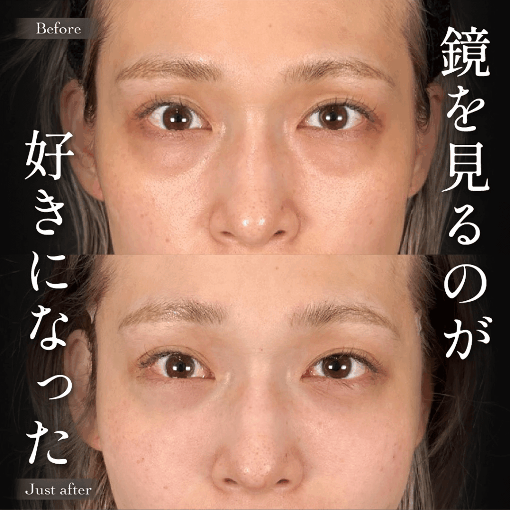 Mirrora式クマ取り ヒアルロン酸