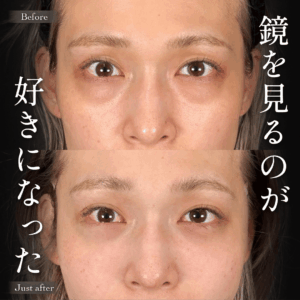 Mirrora式クマ取り ヒアルロン酸