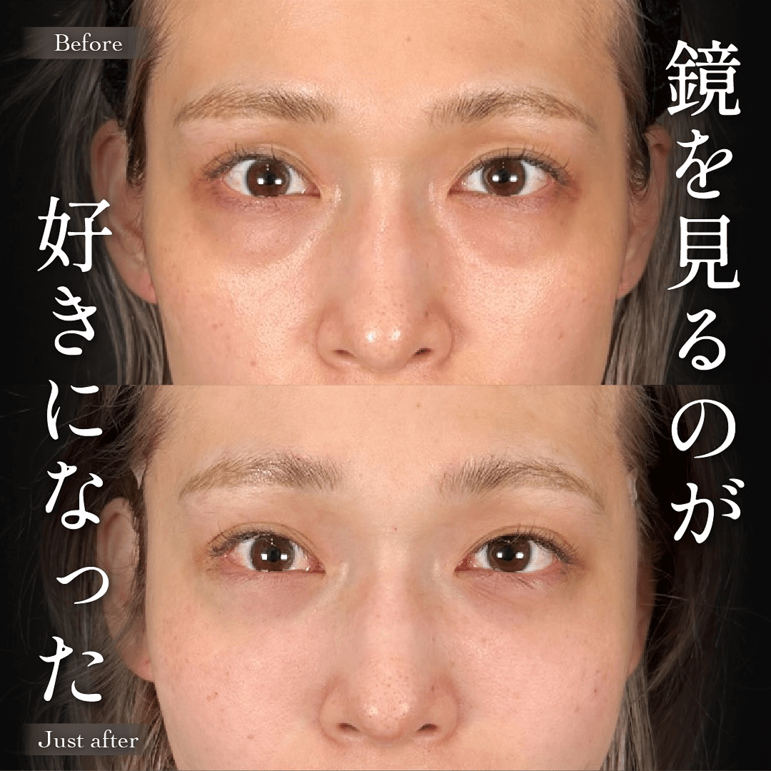 Mirrora式クマ取り ヒアルロン酸