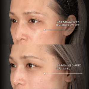 Mirrora式クマ取り ヒアルロン酸