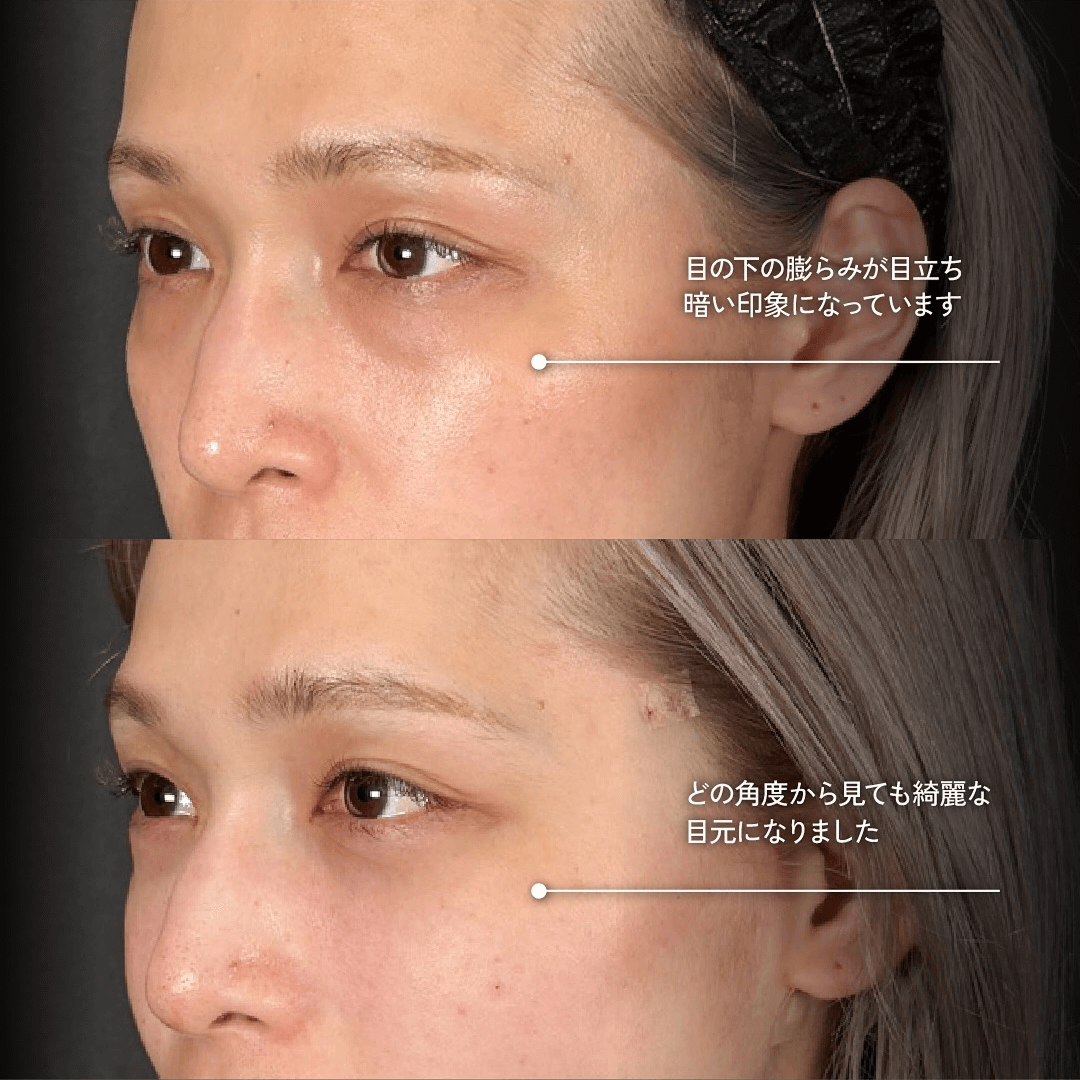 Mirrora式クマ取り ヒアルロン酸