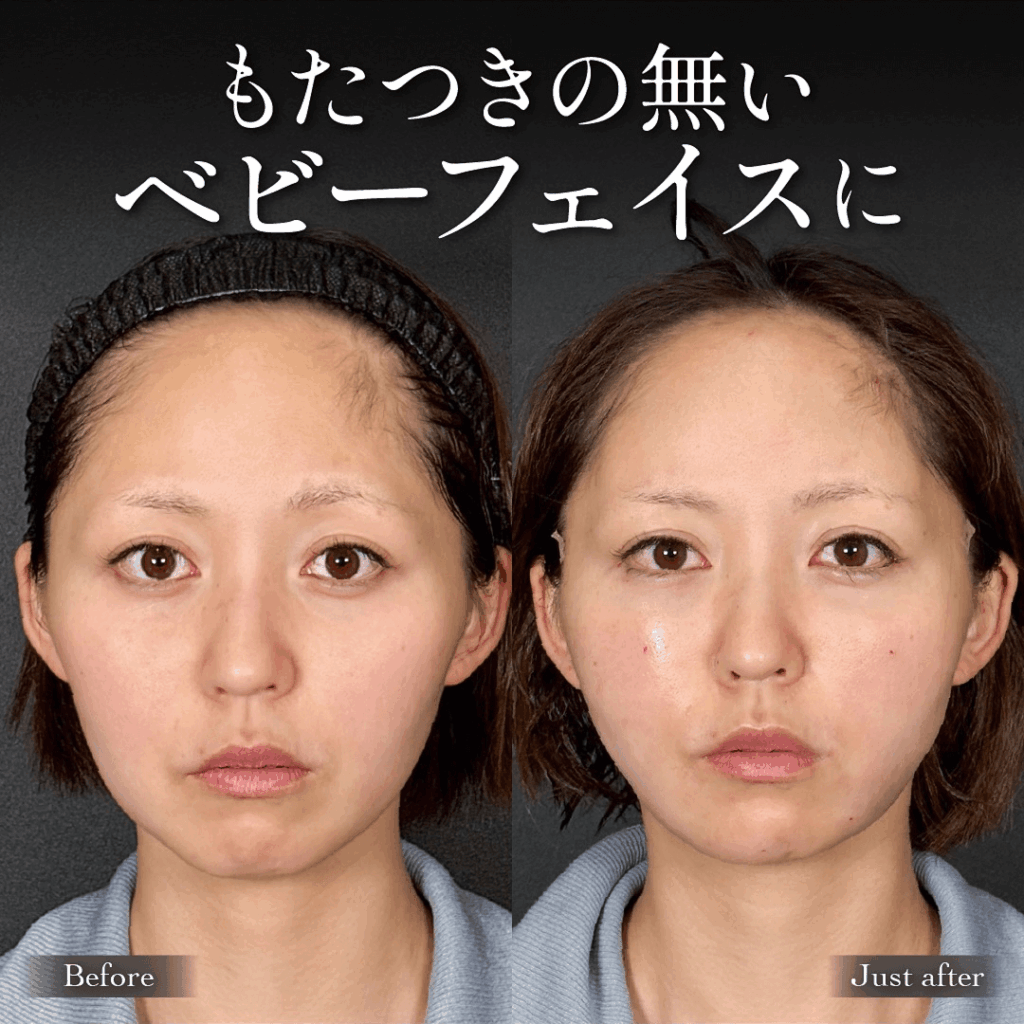 Mirroraリフト 脂肪吸引 脂肪注入