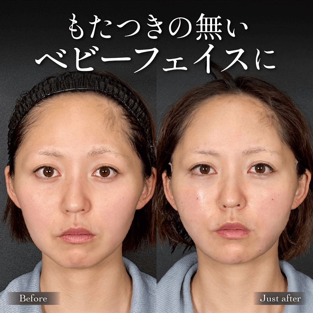 Mirroraリフト 脂肪吸引 脂肪注入