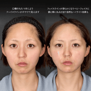 Mirroraリフト 脂肪吸引 脂肪注入