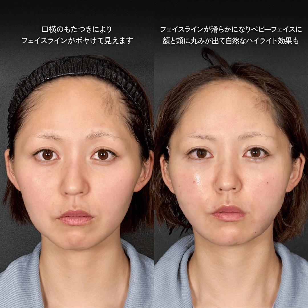 Mirroraリフト 脂肪吸引 脂肪注入