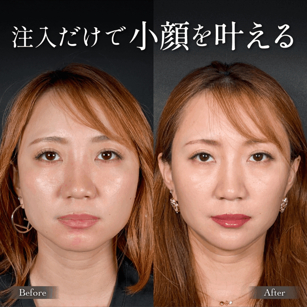 エラボトックス  ヒアルロン酸注入