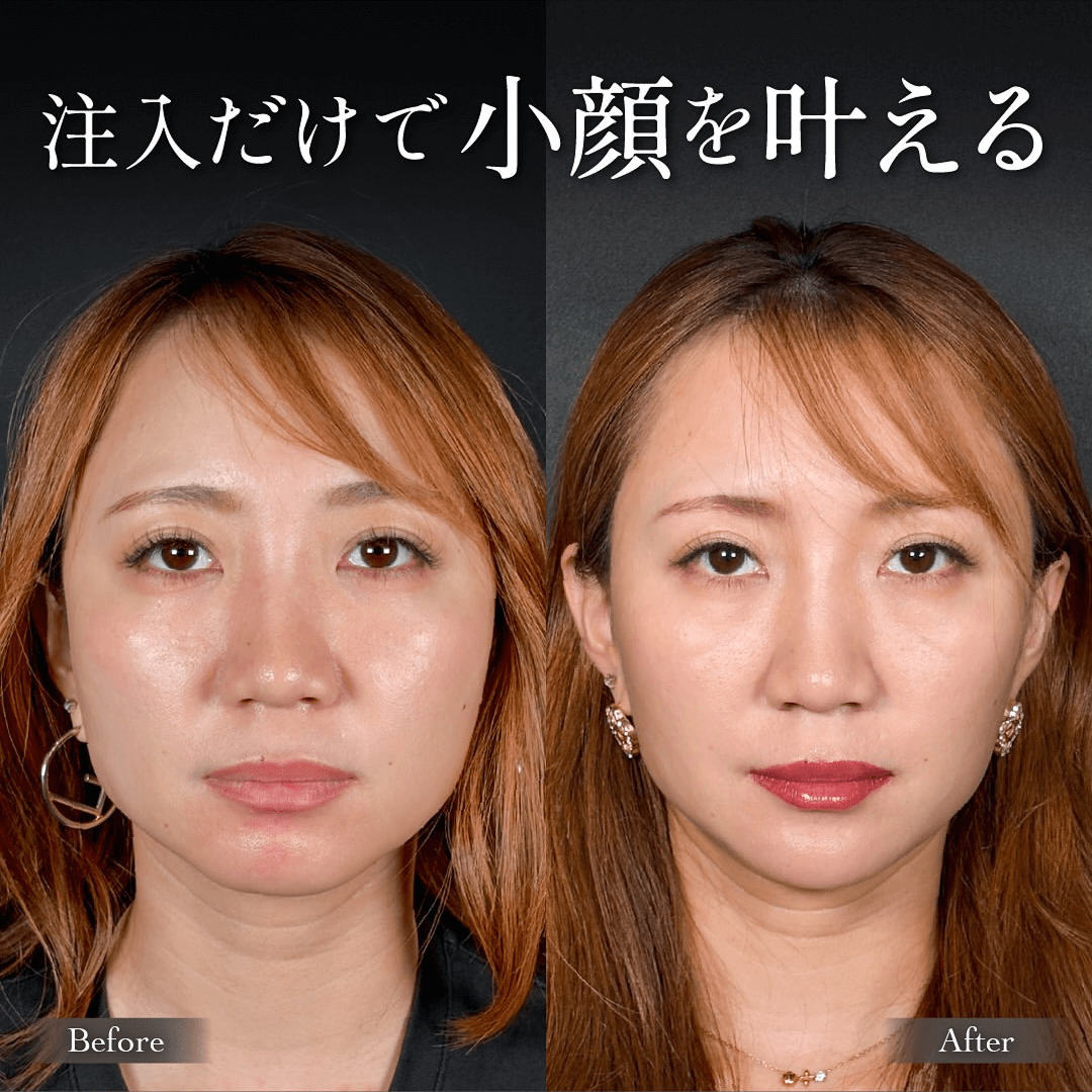 エラボトックス  ヒアルロン酸注入