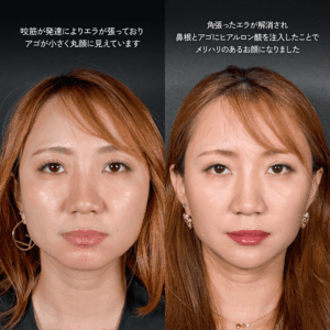 エラボトックス  ヒアルロン酸注入