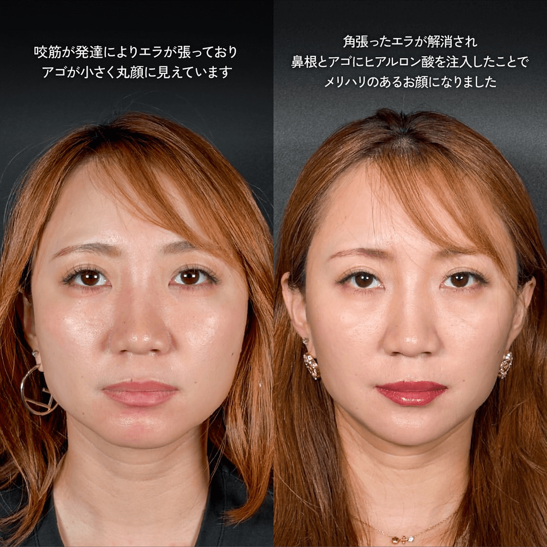 エラボトックス  ヒアルロン酸注入