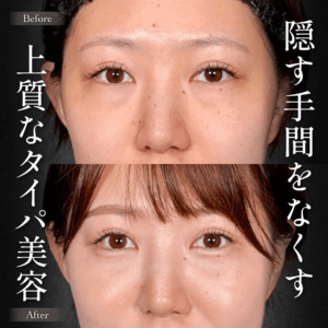 Mirrora式クマ取り ヒアルロン酸