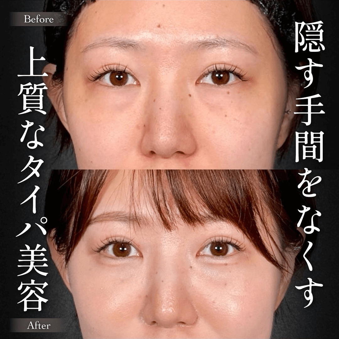 Mirrora式クマ取り ヒアルロン酸