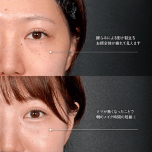 Mirrora式クマ取り ヒアルロン酸