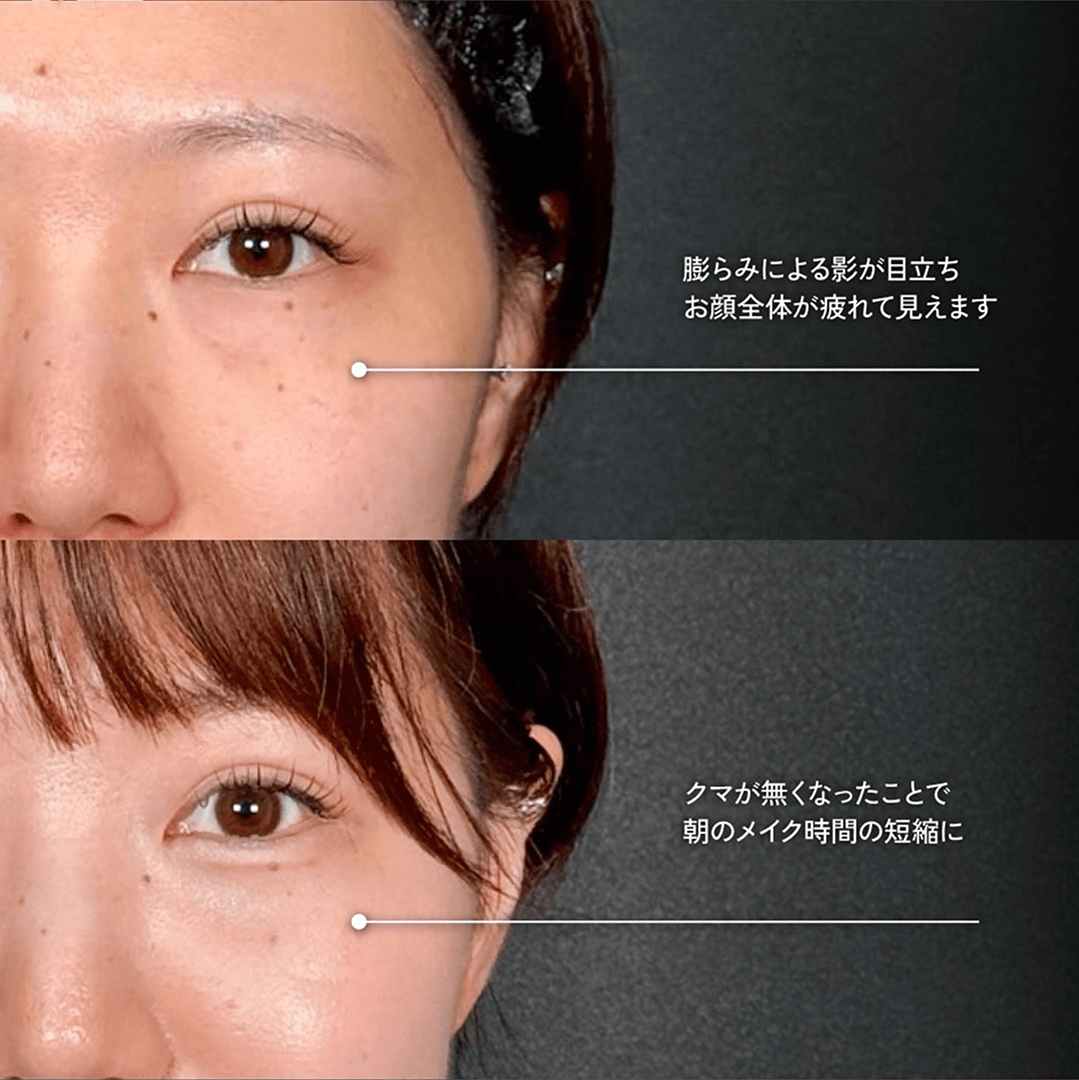 Mirrora式クマ取り ヒアルロン酸