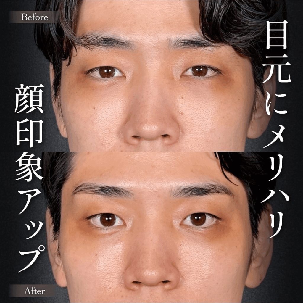 Mirrora式クマ取り ヒアルロン酸