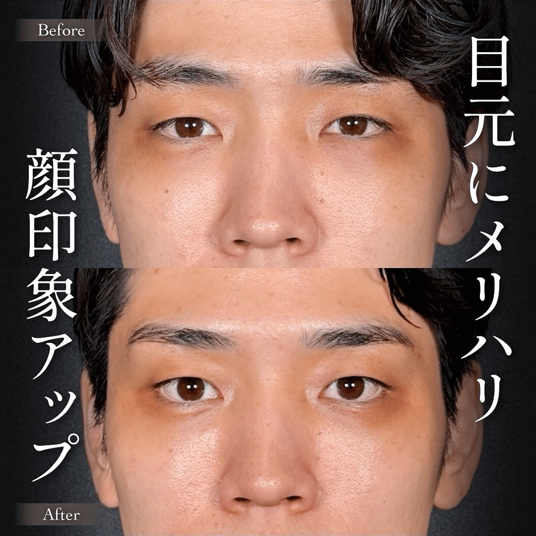 Mirrora式クマ取り ヒアルロン酸