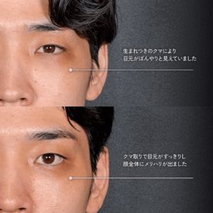 Mirrora式クマ取り ヒアルロン酸