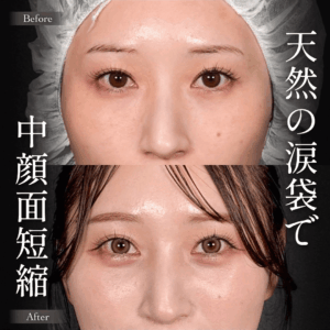 Mirrora式クマ取り