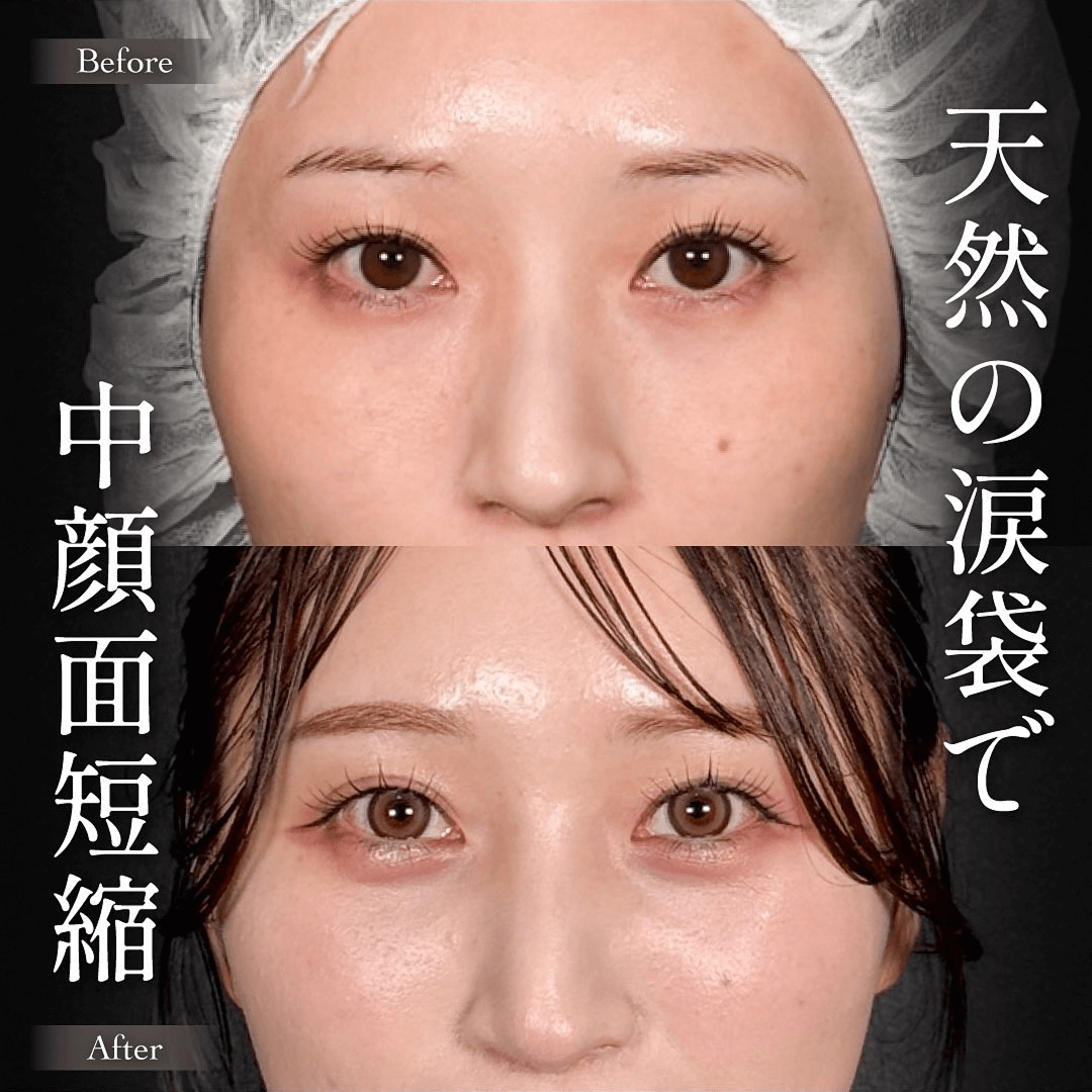 Mirrora式クマ取り