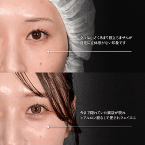 Mirrora式クマ取り