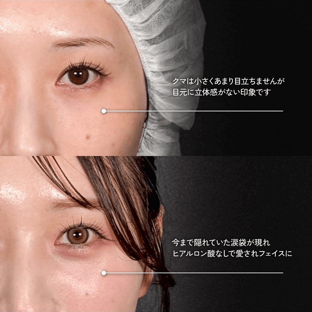 Mirrora式クマ取り