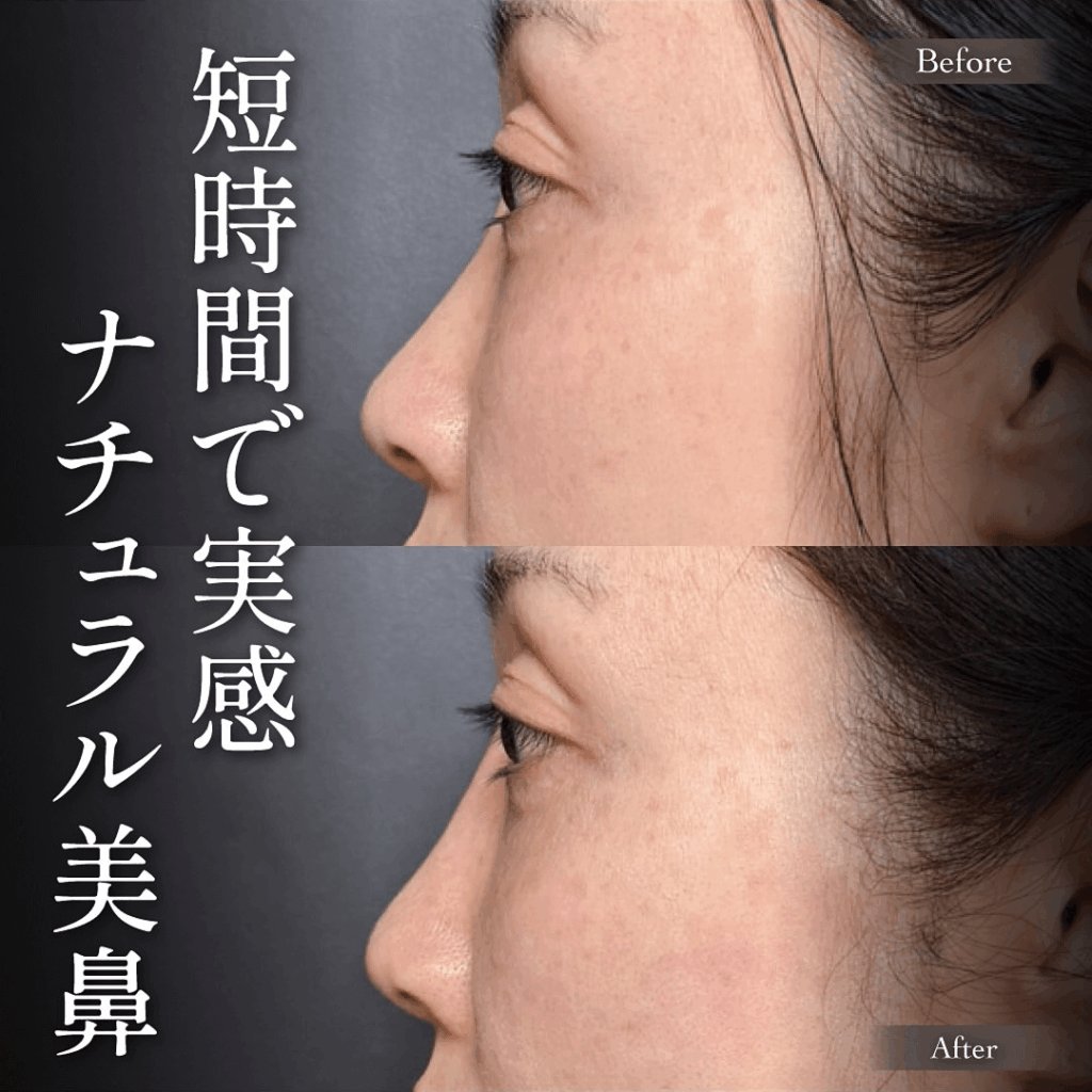 ヒアルロン酸注入