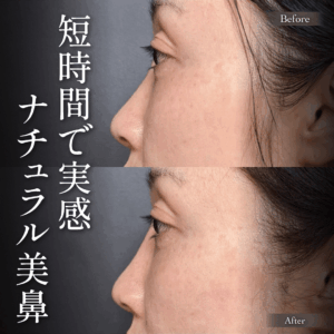 ヒアルロン酸注入