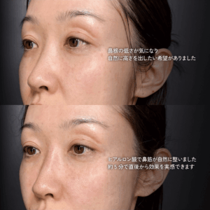 ヒアルロン酸注入