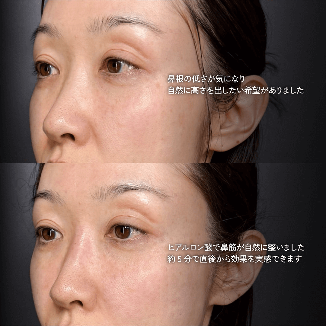 ヒアルロン酸注入