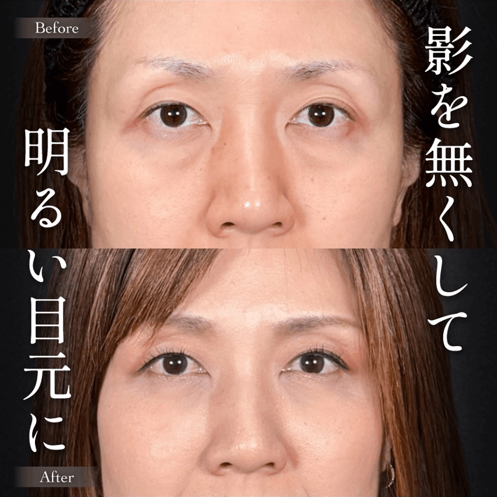 Mirrora式クマ取り