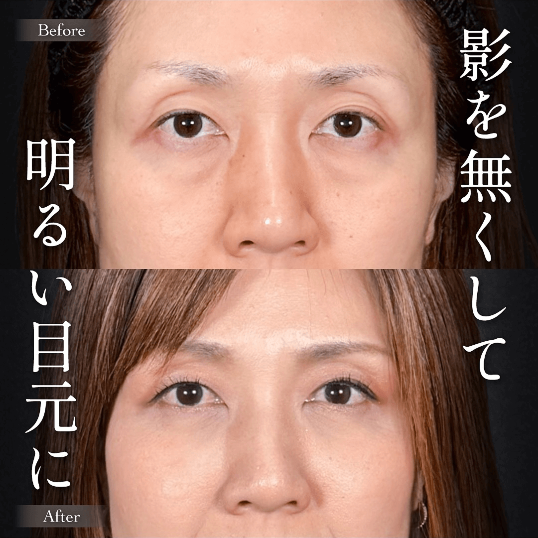 Mirrora式クマ取り