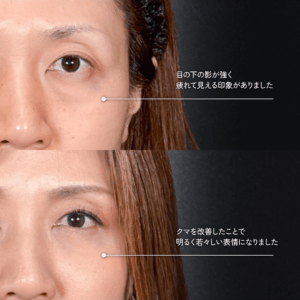 Mirrora式クマ取り