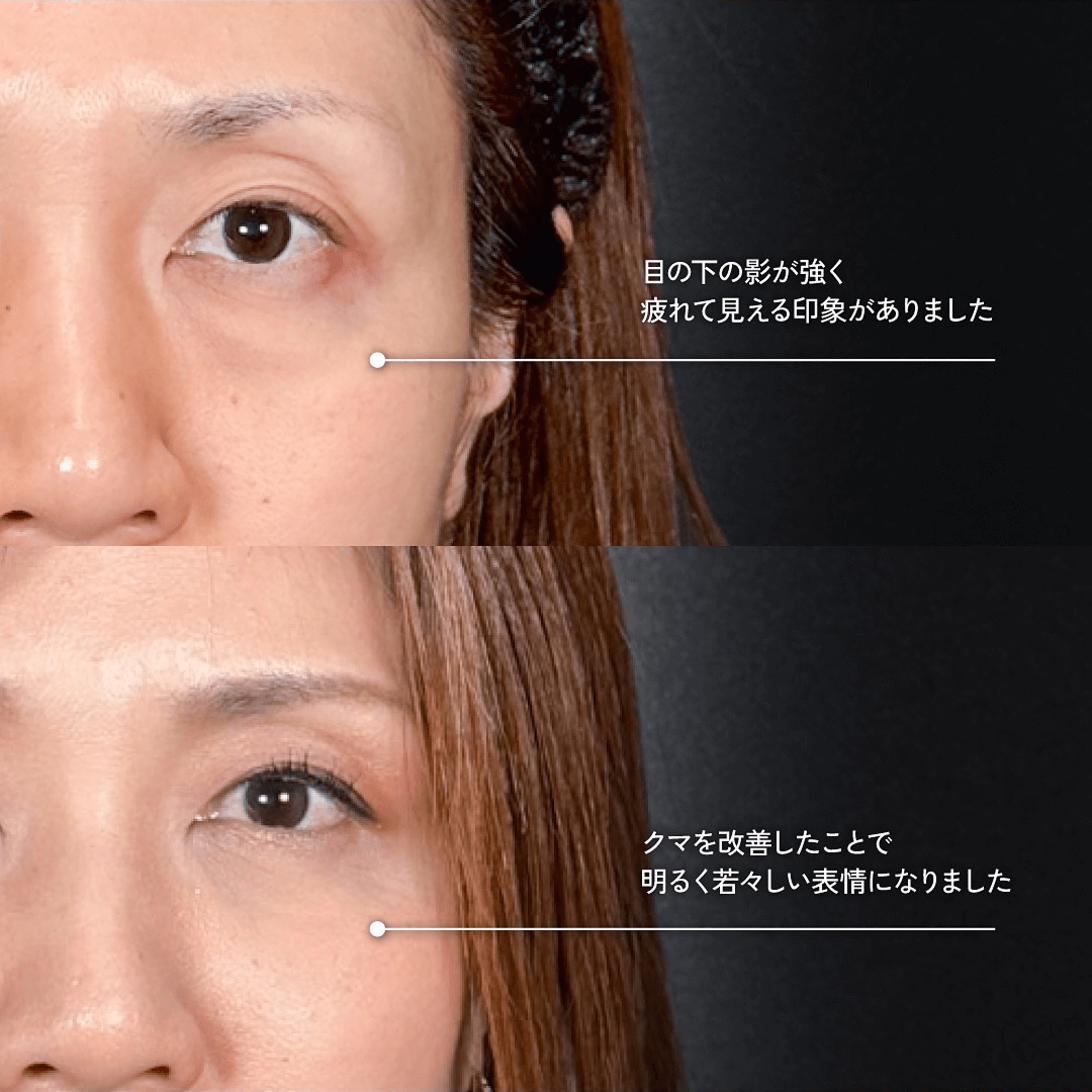 Mirrora式クマ取り