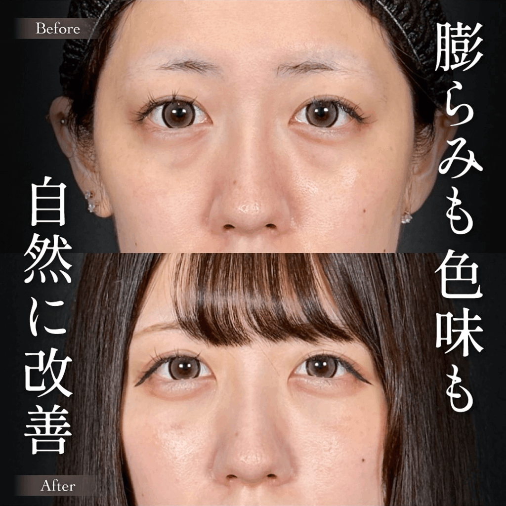 Mirrora式クマ取り ヒアルロン酸