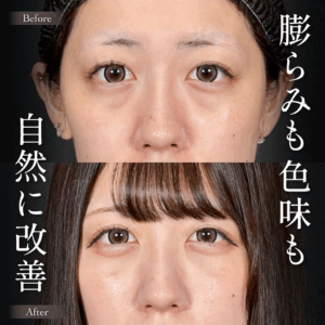 Mirrora式クマ取り ヒアルロン酸