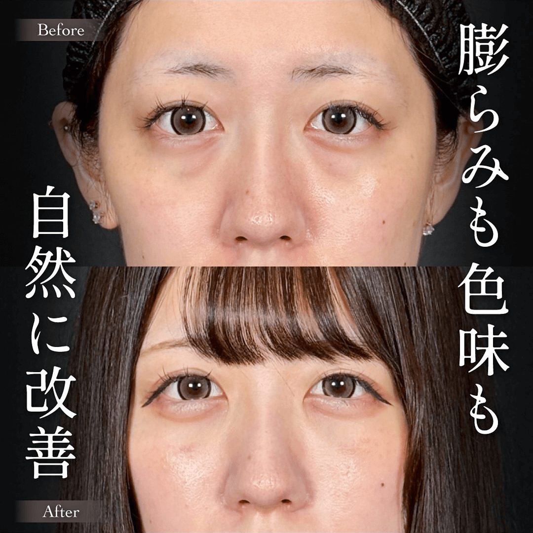 Mirrora式クマ取り ヒアルロン酸