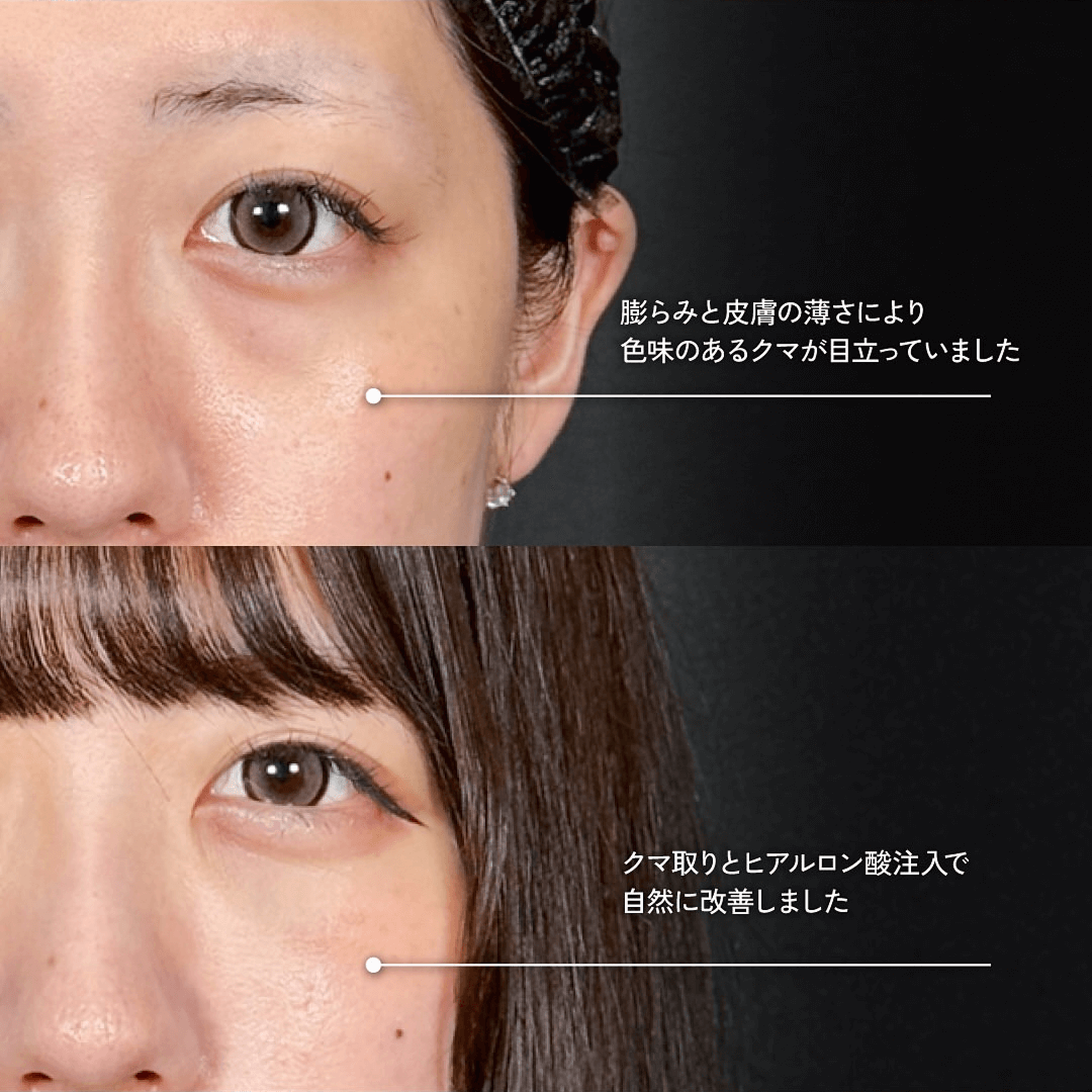 Mirrora式クマ取り ヒアルロン酸