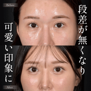 Mirrora式クマ取り 脂肪注入