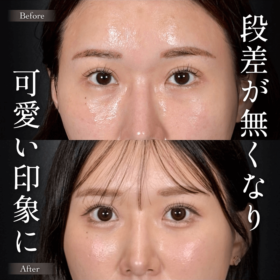 Mirrora式クマ取り 脂肪注入