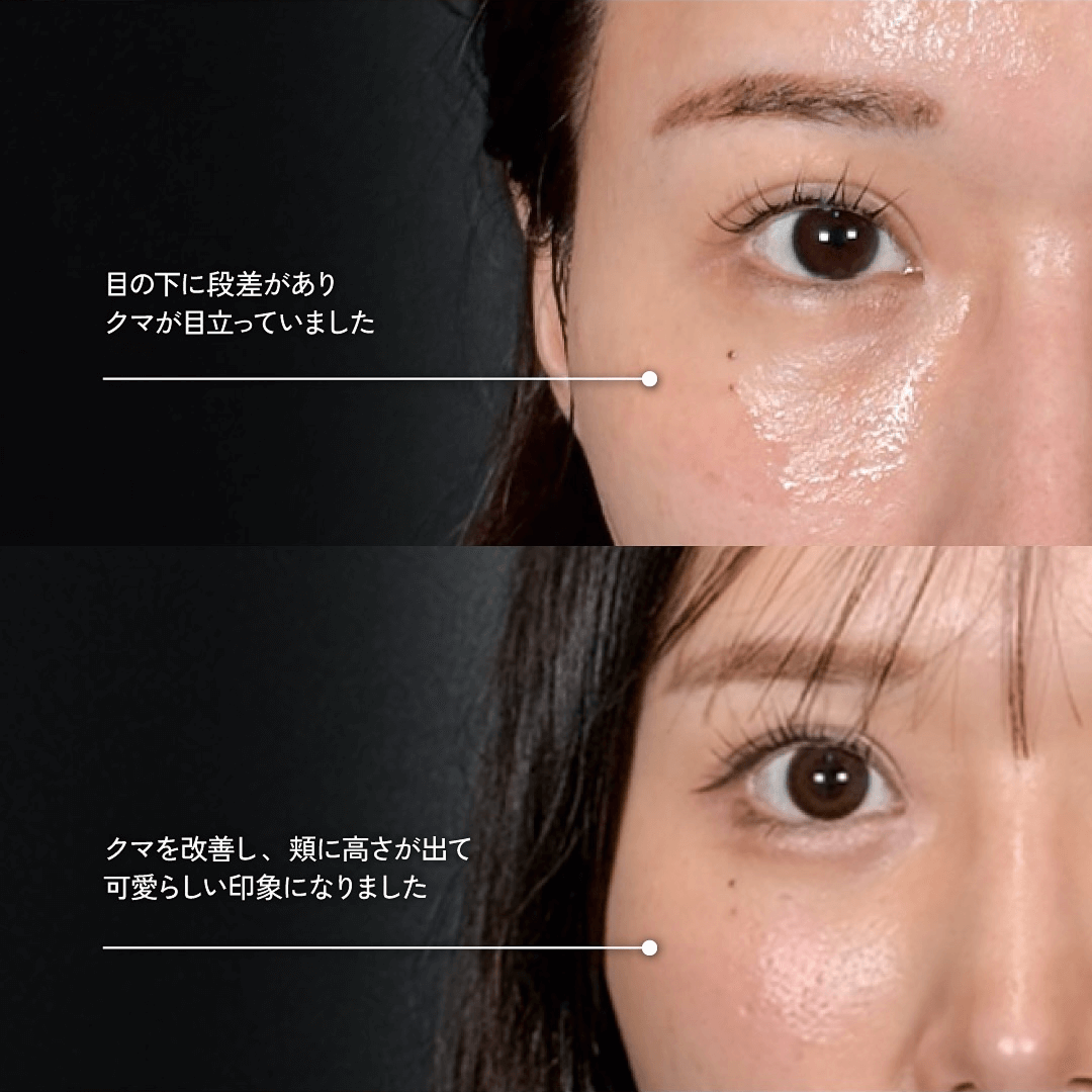 Mirrora式クマ取り 脂肪注入