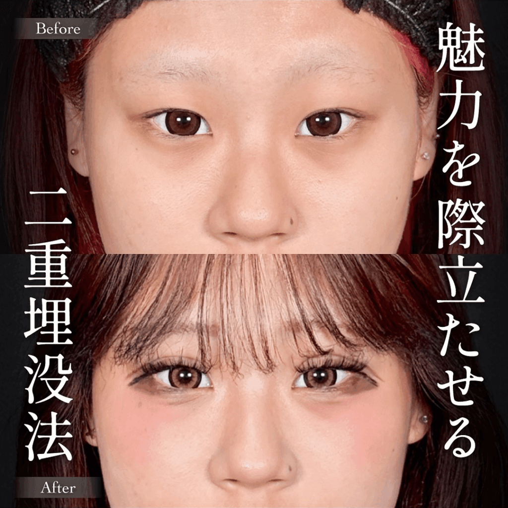 Mirrora式二重埋没