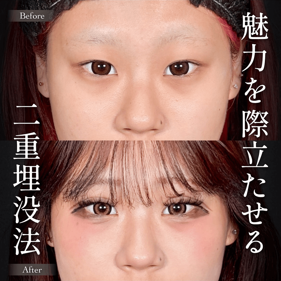 Mirrora式二重埋没