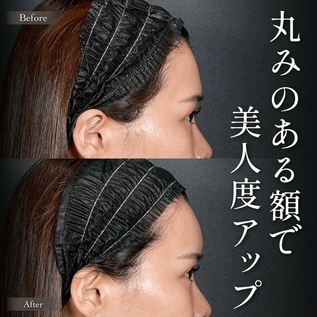 ヒアルロン酸注入